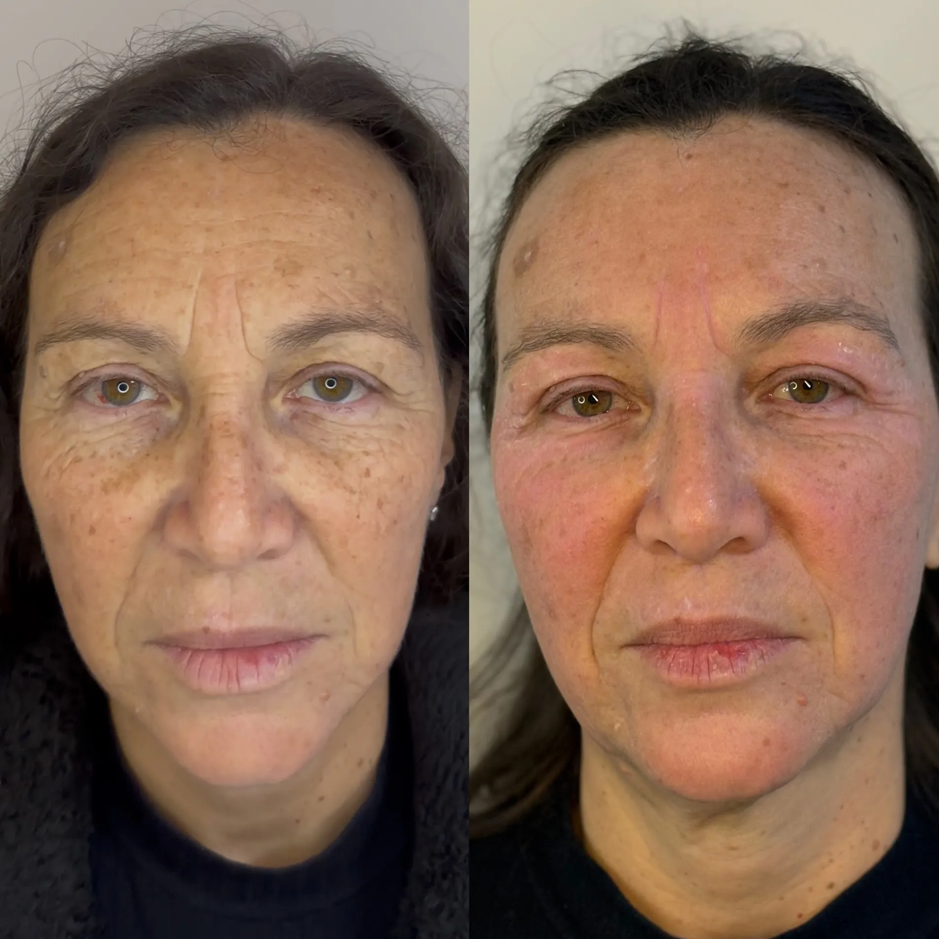 Antes e depois — comparativo facial de acompanhamento da qualidade da pele