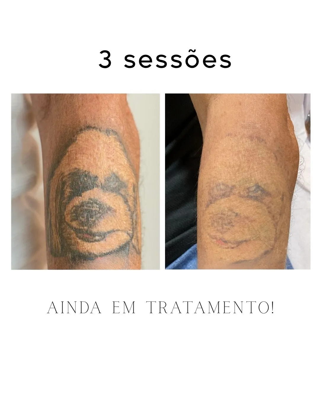 Antes e depois — clareamento de tatuagem preta no antebraço