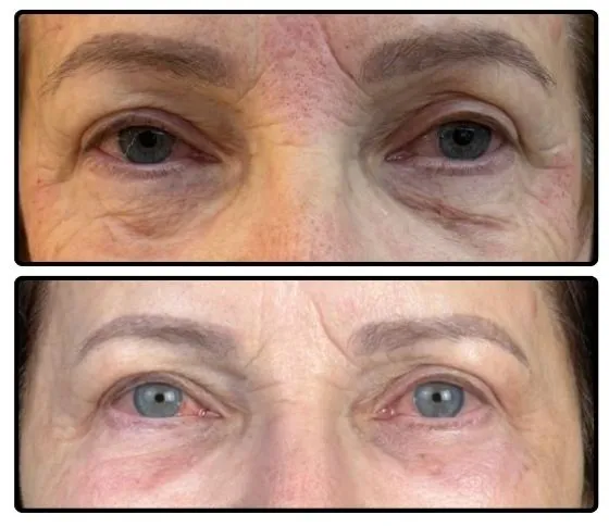 Antes e depois — comparativo antes e depois da região dos olhos