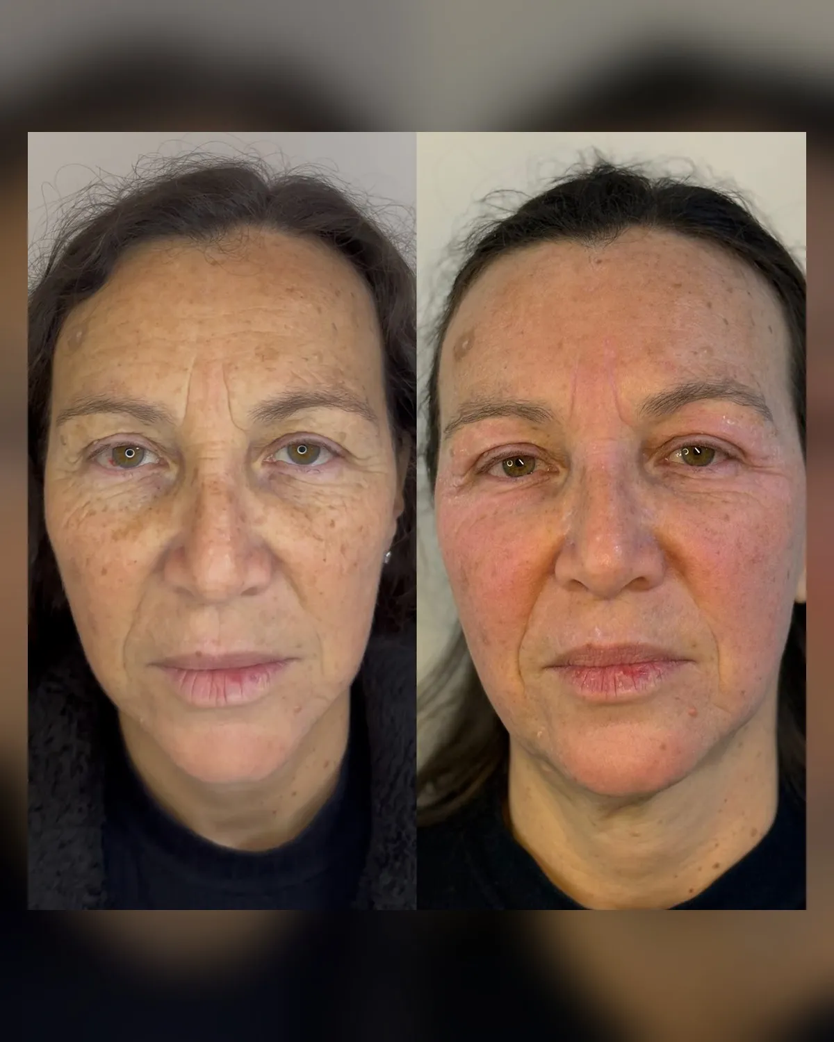 comparativo de evolução facial