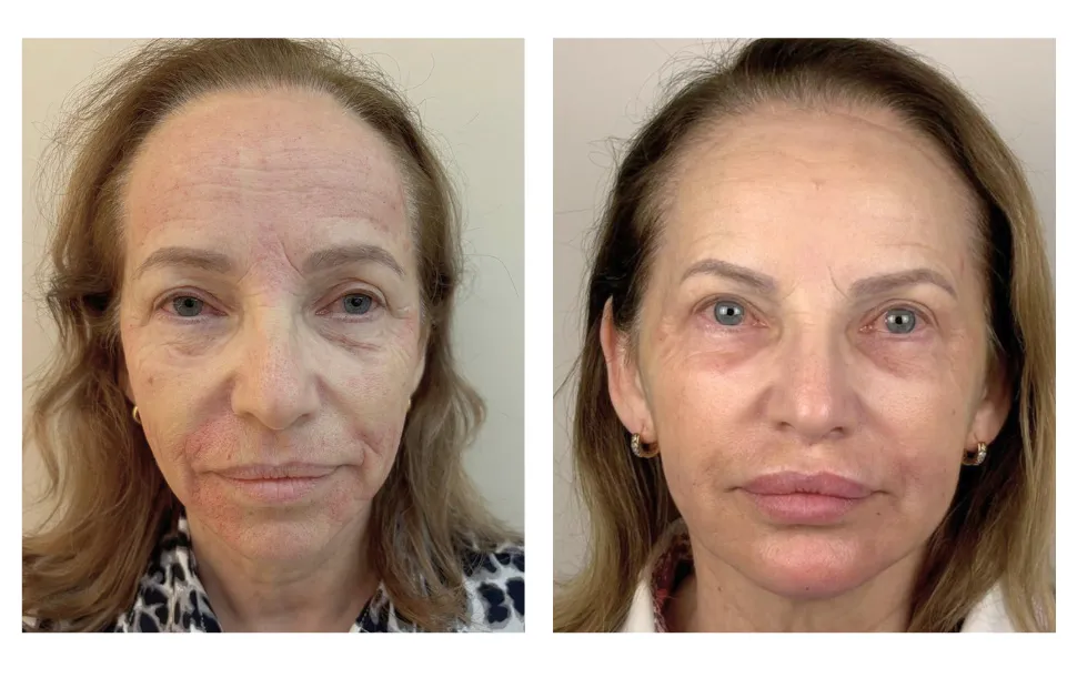Antes e depois — comparativo frontal antes e depois de harmonização facial