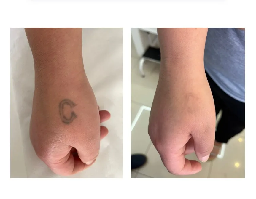 Antes e depois — evolução da remoção de pequena tatuagem preta na mão