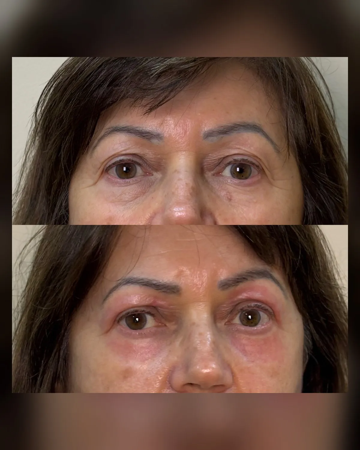 comparativo de acompanhamento da região dos olhos