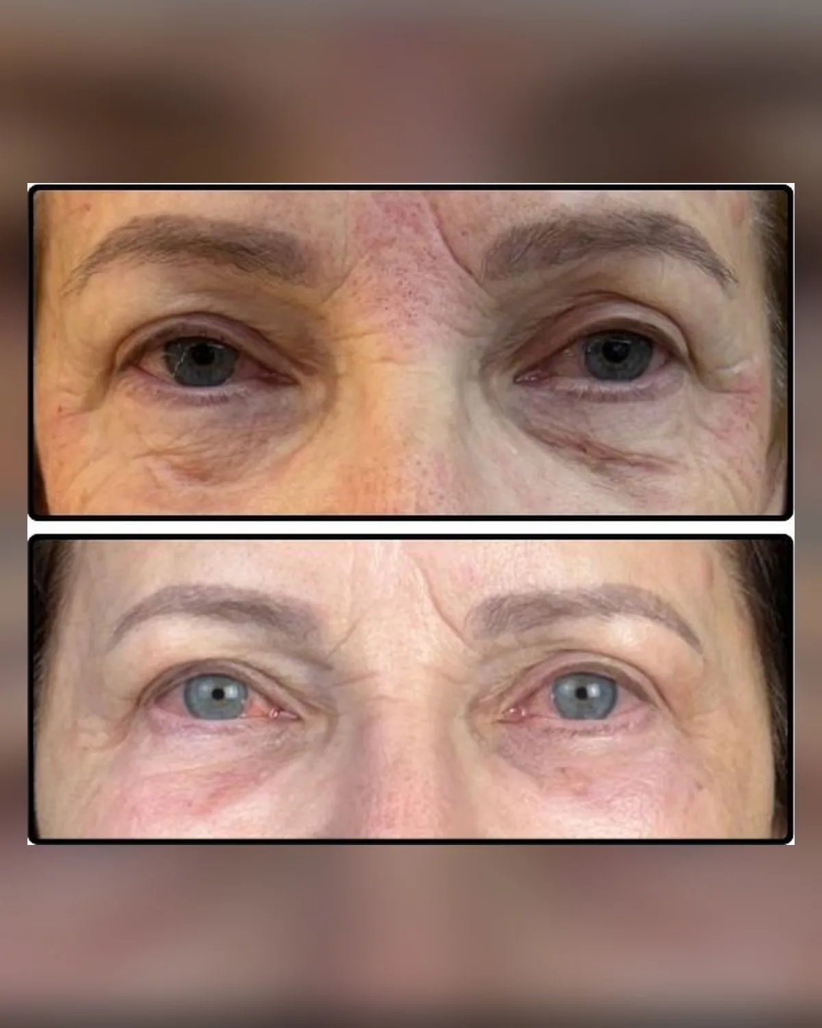 comparativo da região dos olhos