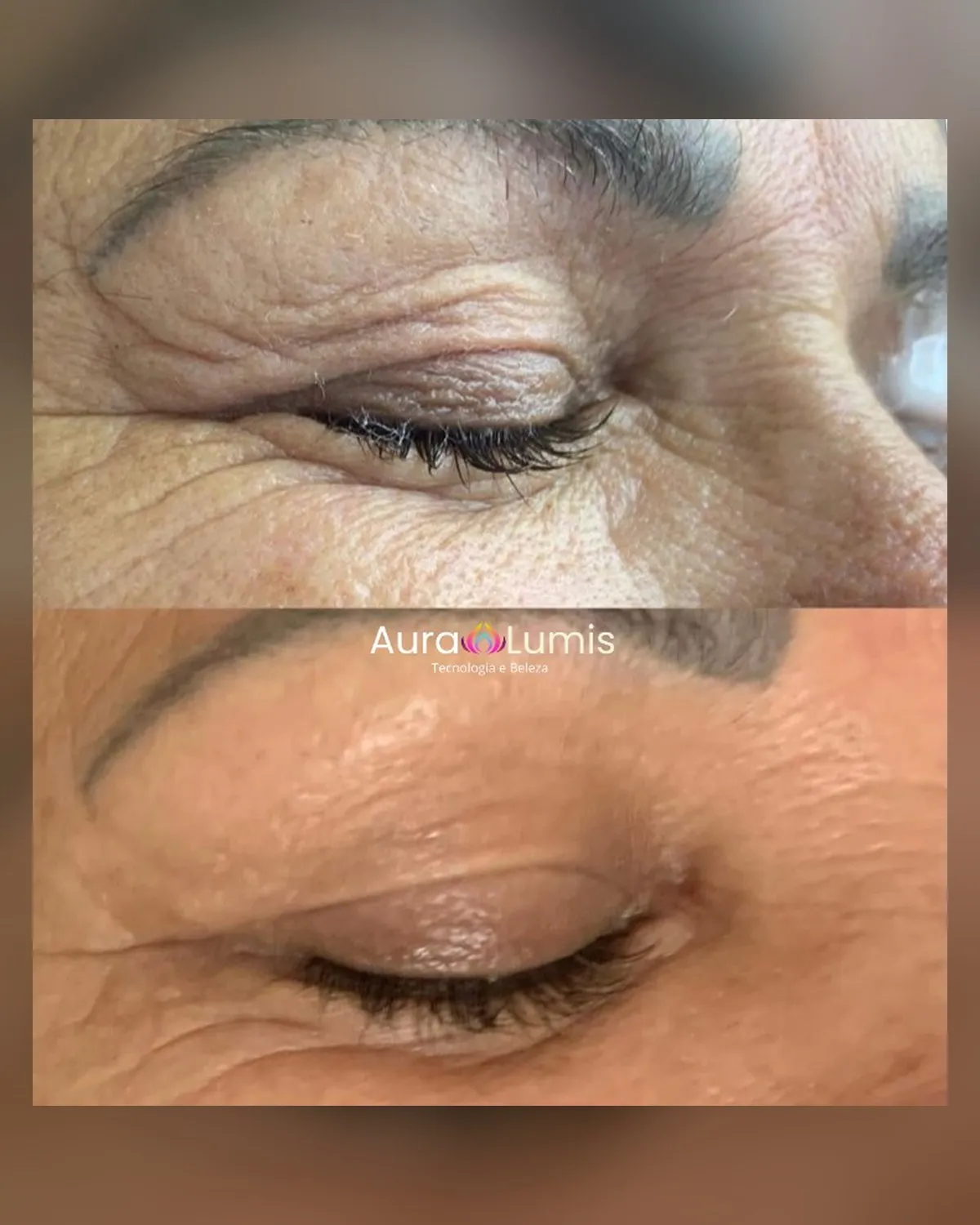 comparativo da pele ao redor dos olhos