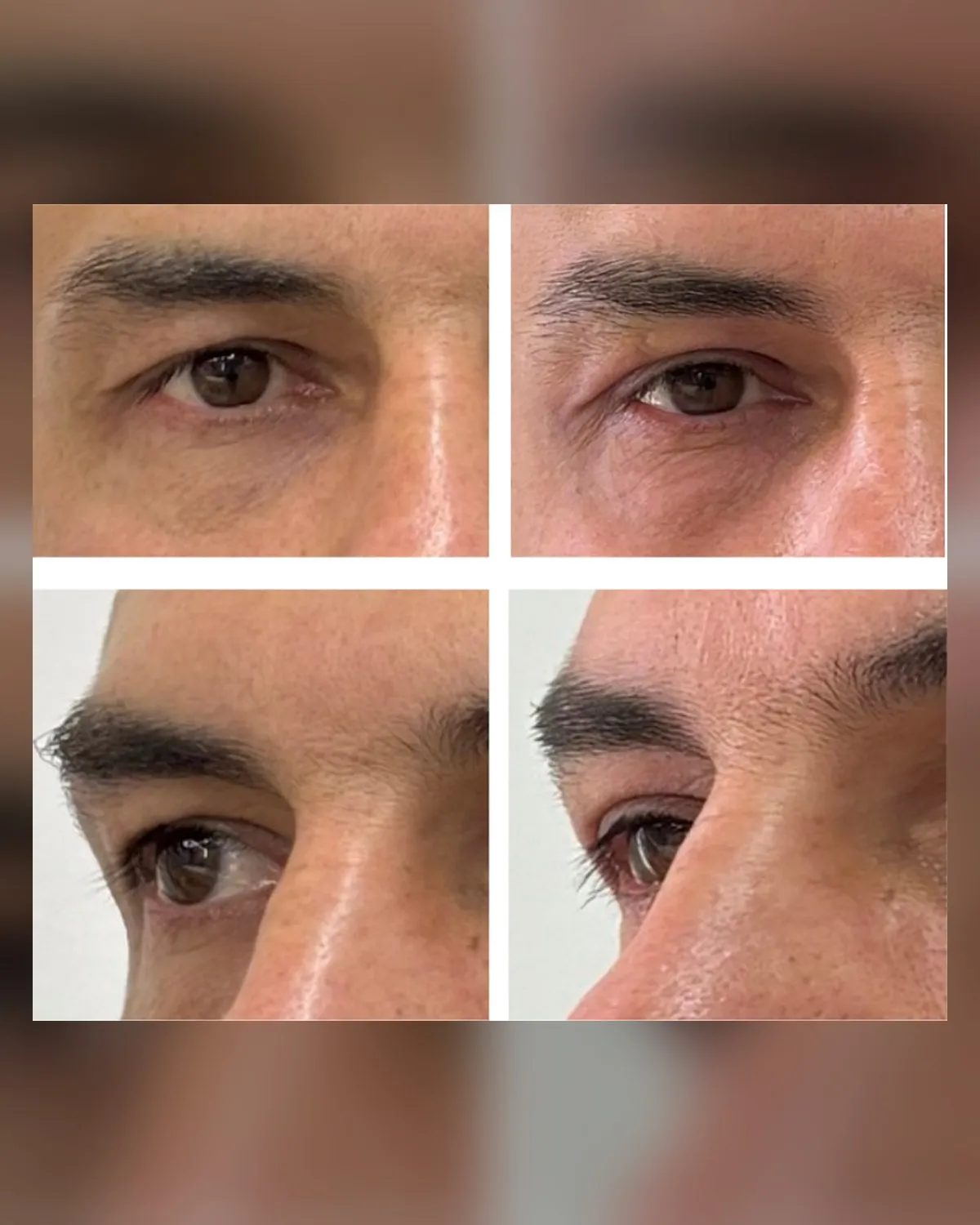 comparativo da região abaixo dos olhos em dois ângulos
