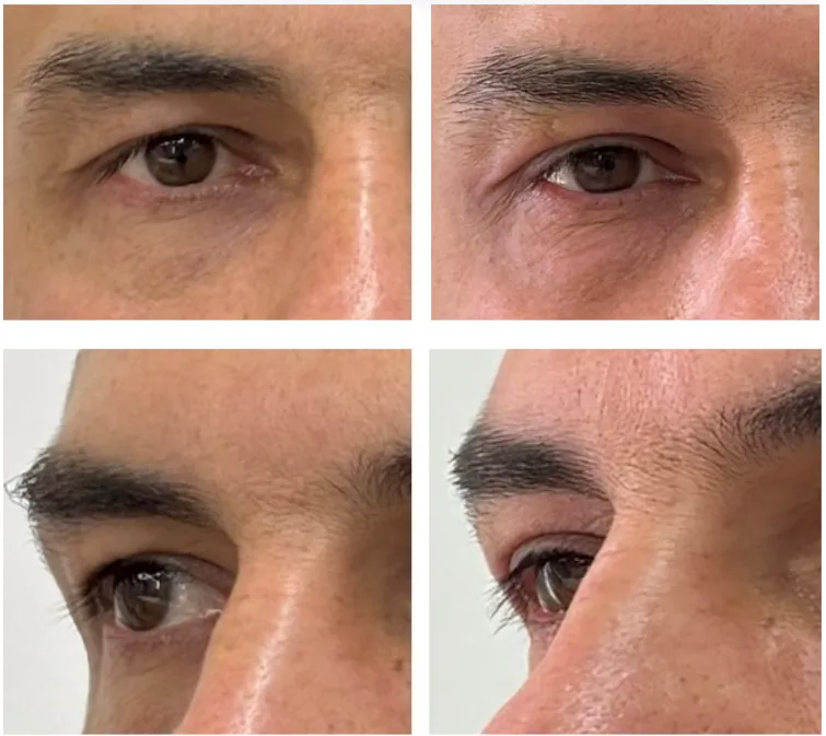 Antes e depois — comparativo masculino da região dos olhos em diferentes ângulos