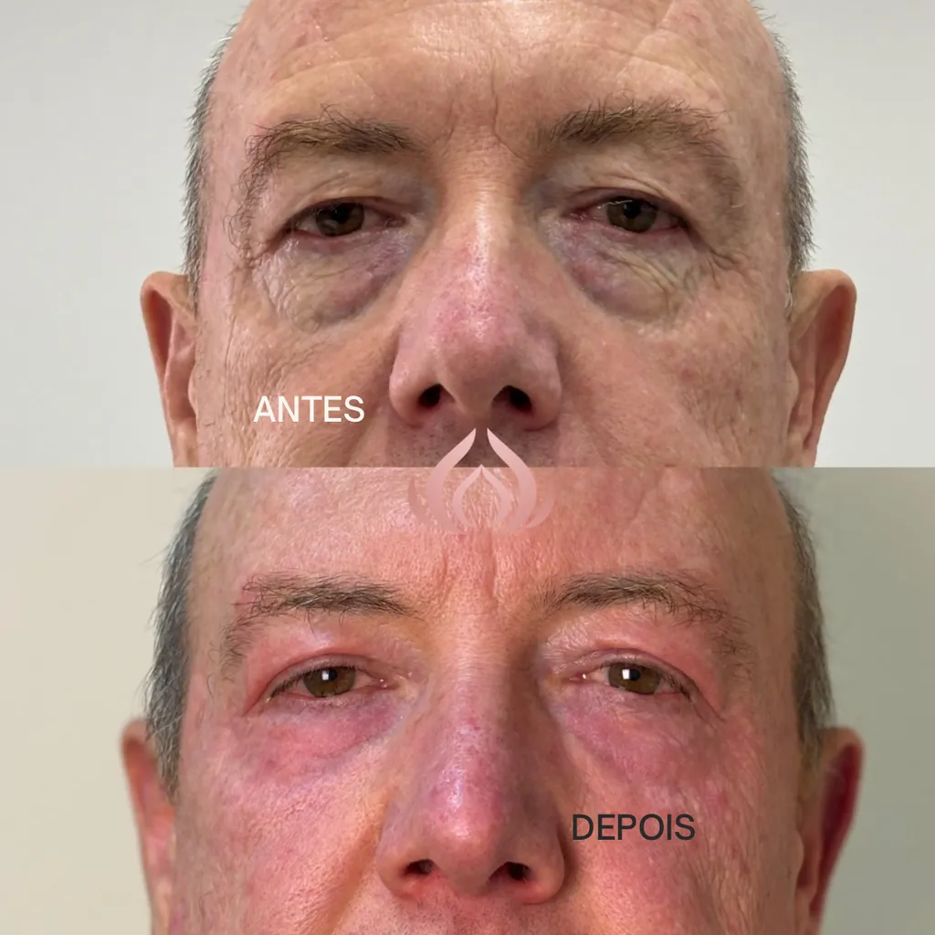 comparativo masculino antes e depois da região dos olhos
