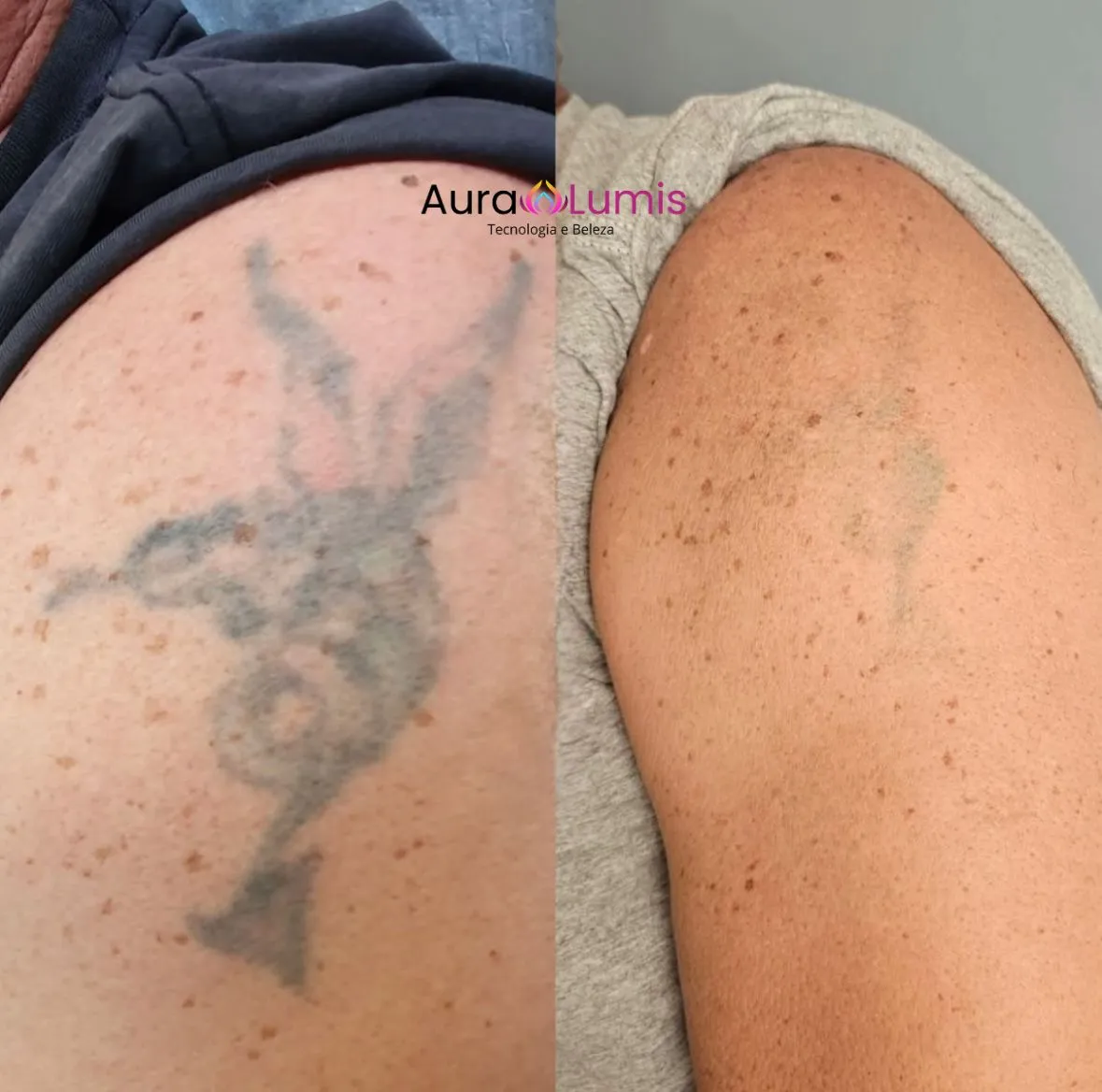 Antes e depois — clareamento de tatuagem escura no ombro