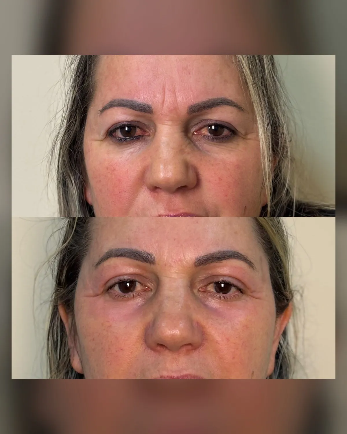 comparativo da evolução da pele após tratamento facial