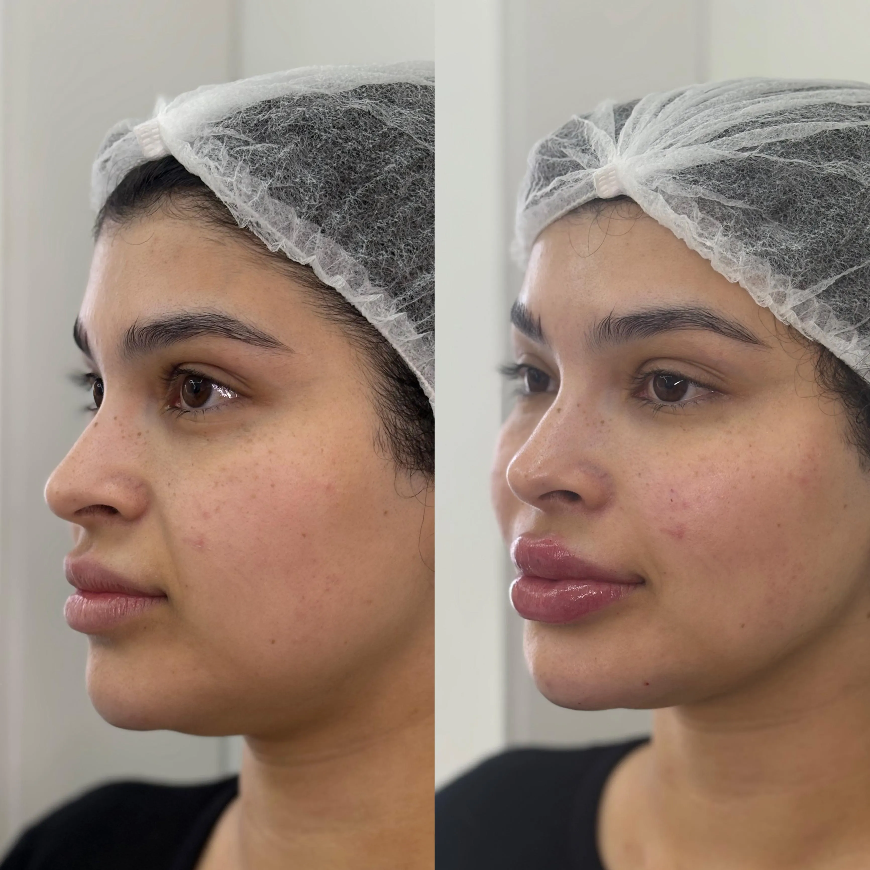 Antes e depois — comparativo lateral antes e depois de preenchimento labial