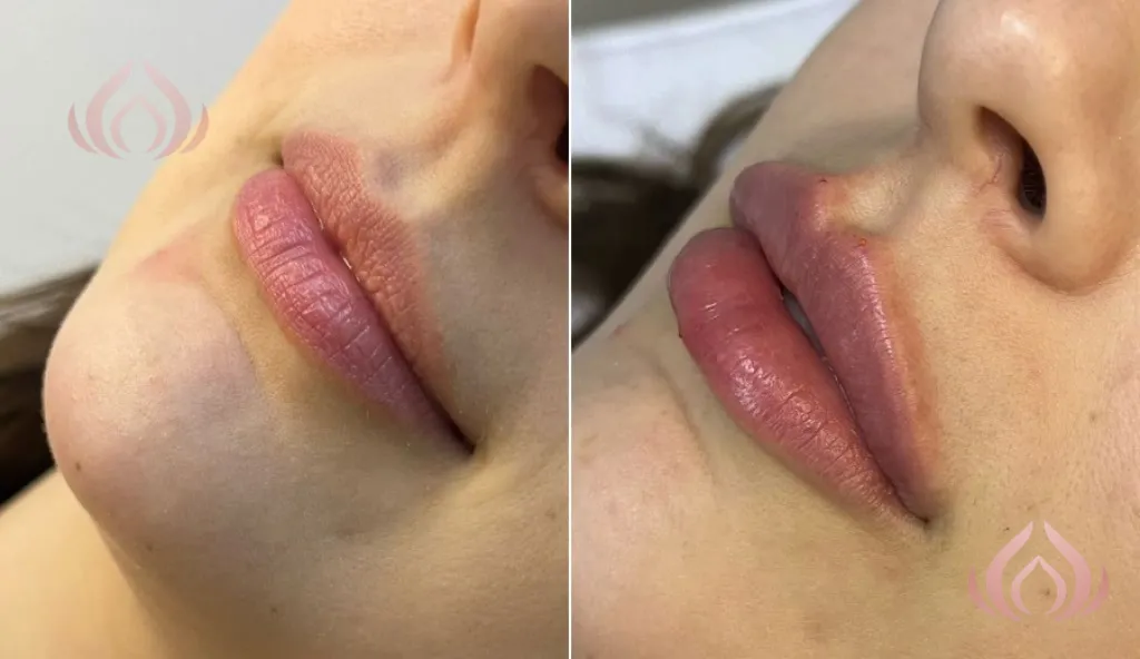Antes e depois — comparativo aproximado antes e depois de preenchimento labial