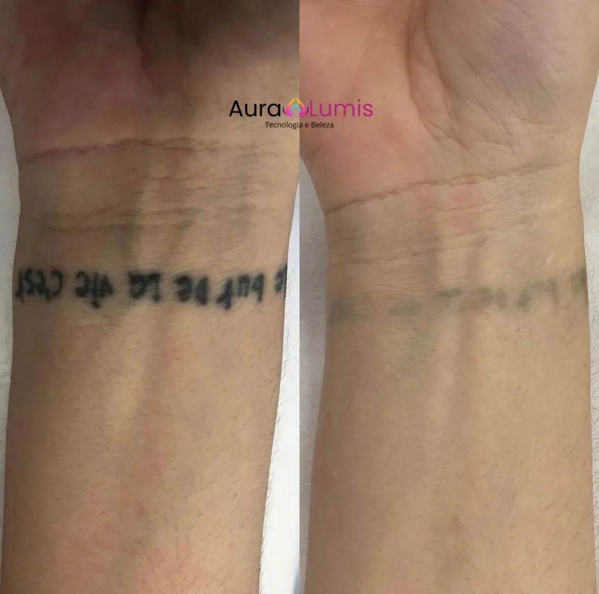 Antes e depois — clareamento de tatuagem de escrita no punho