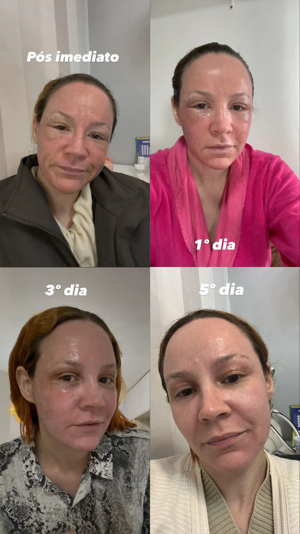 Antes e depois — sequência de quatro registros da recuperação de Alexsandra após laser de CO₂, no pós imediato, primeiro, terceiro e quinto dias