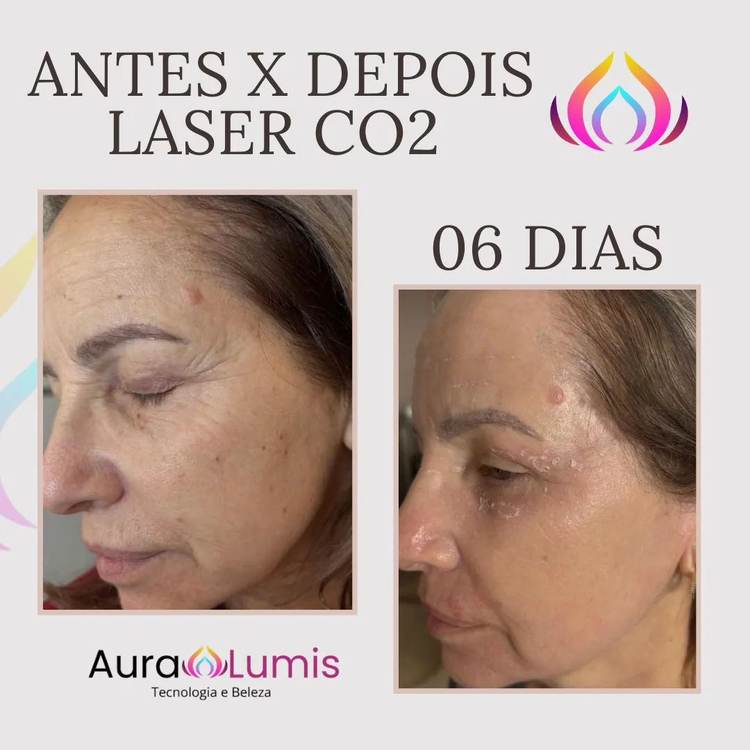 Antes e depois — pele facial antes do laser de CO₂ e no sexto dia de recuperação