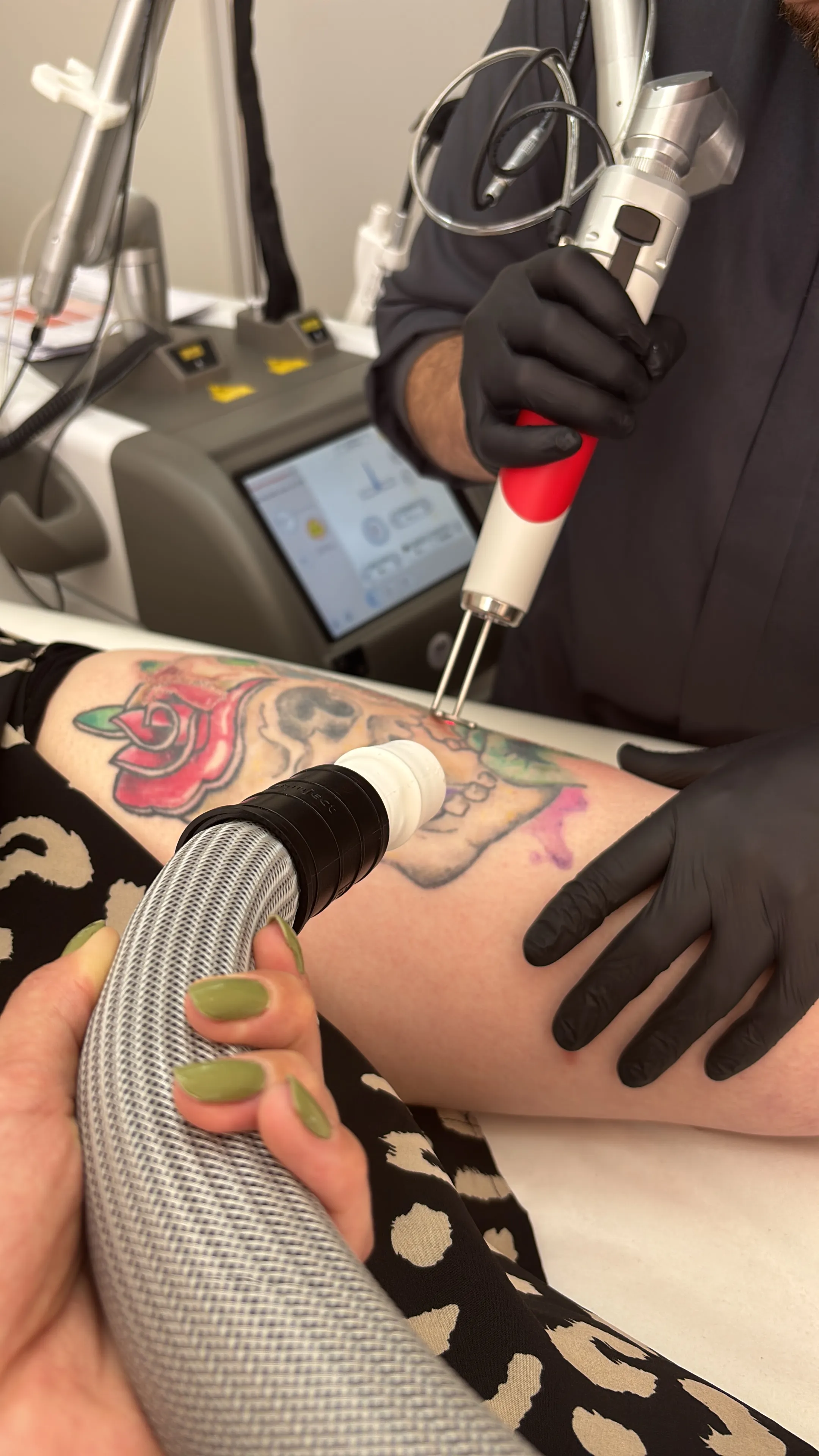 Sessão real de remoção de tatuagem a laser na Auralumis